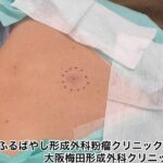 【閲覧注意】粉瘤(ふんりゅう)の手術、スゴすぎるｗｗｗｗｗｗｗｗｗ